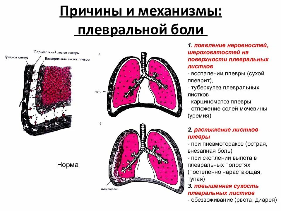 Плеврит боль. Локализация боли при плеврите. Боль в груди при плеврите. Как отличить боль в легких