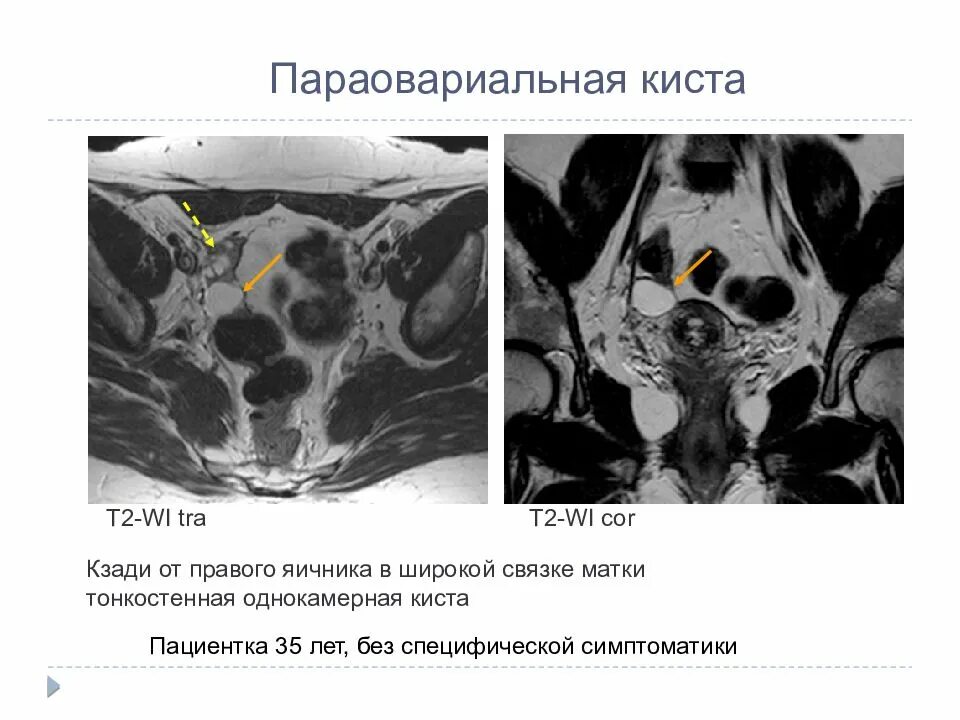 Киста яичника на мрт. Параовариальные кисты яичников мрт. Параовариальная киста мрт. Параовариальная киста яичника.