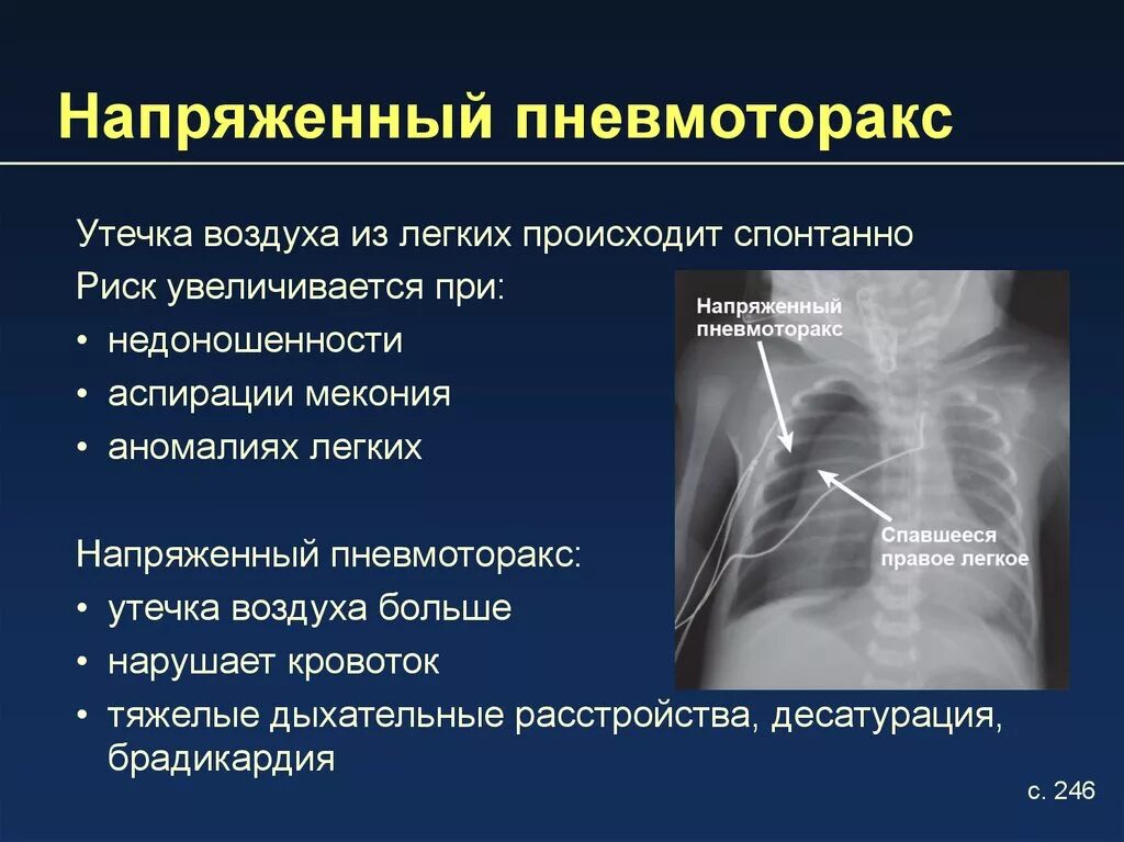 Легкие и плевральная полость. Спонтанный пневмоторакс рентген. Пневмоторакс легкого рентген. Легкие напряжены. Клапанный пневмоторакс механизм развития.