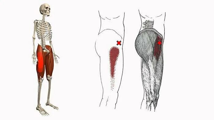 Болезненность в левой ягодице. Триггерные точки на ягодицах. Миофасциальный синдром грушевидной мышцы. Триггерные точки области тазобедренного сустава. В ягодице слева.