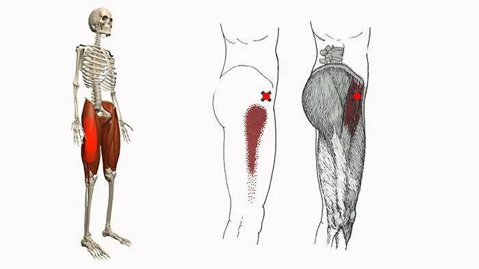 Триггерные точки бедра. Триггерные точки тазобедренного сустава. Триггерные точки мышц таза. Ягодичная мышца и тазобедренный сустав. Сильная боль в бедре
