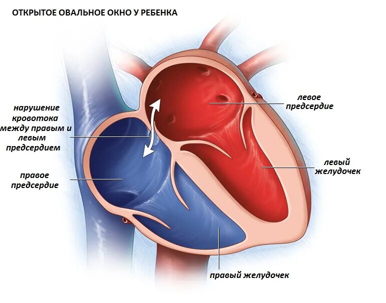 Окно в сердце у новорожденного. Foramen ovale сердце. открытое овальное окошко у новорожденного. незакрытое овальное окно в сердце у новорожденного. открытое овальное окно в сердце у новорожденного 2мм.