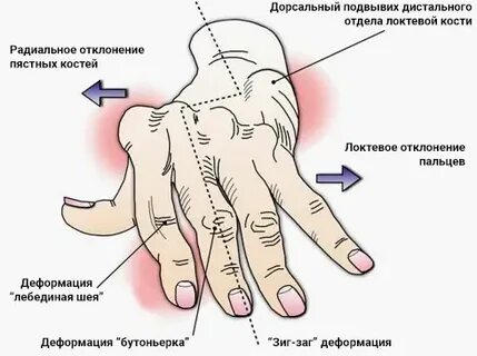 Болят запястья рук причины и лечение