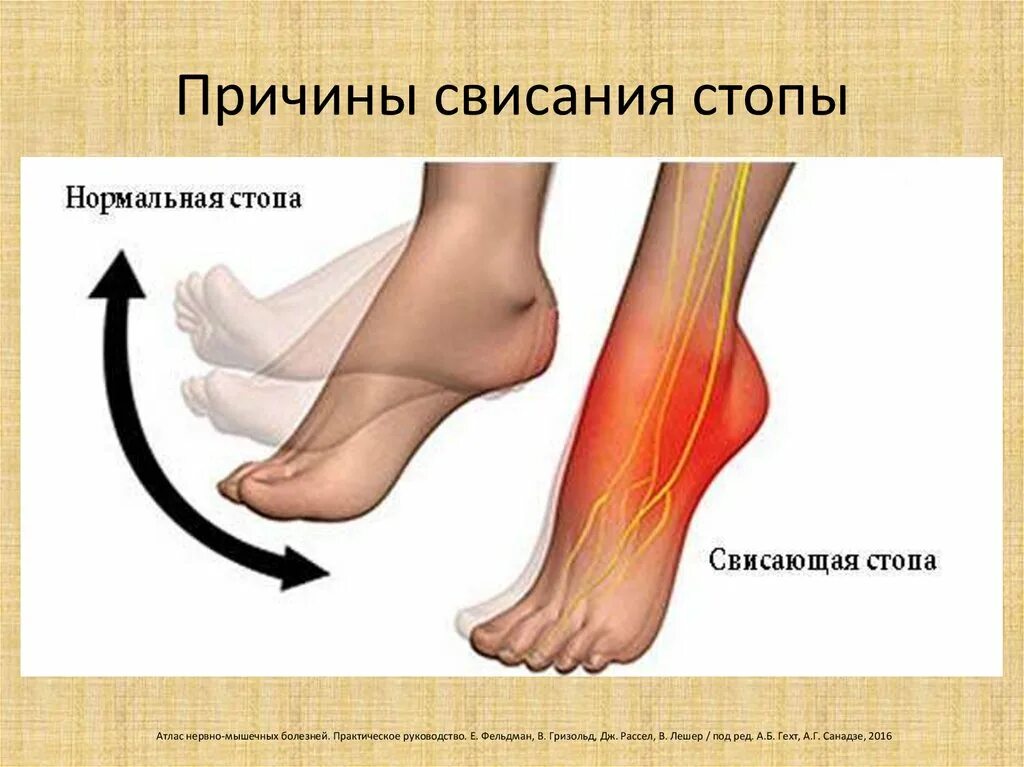 Парез стопы. Нейропатия большеберцового нерва. Невропатия малоберцового нерва лекарства. Нейропатия малоберцового нерва. Невропатия (неврит) большеберцового нерва.