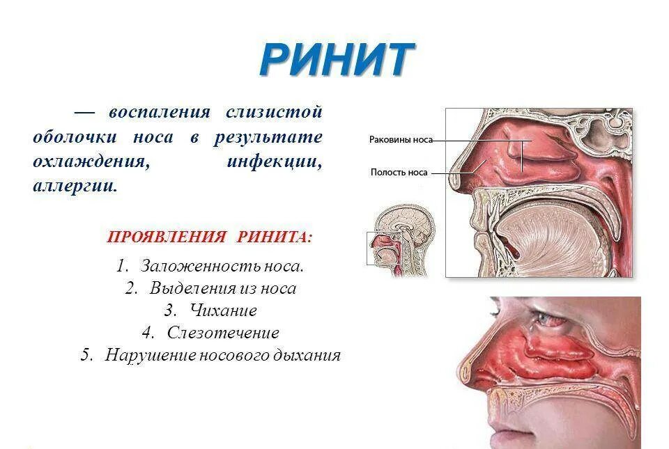 Постоянно заложен нос причины. Ринит это заболевание носовой полости. Слизистая оболочка носа при аллергическом рините. Воспаление слизистой оболочки носовой полости. Аллергический ринит вазомоторный ринит.