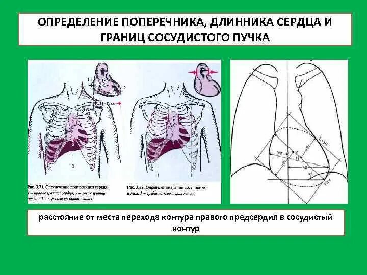 Мс сердца. Аортальная конфигурация сердца длинник и поперечник. Поперечник и длинник сердца в норме. Определение длинника и поперечника сердца. Норма длинника и поперечника сердца.