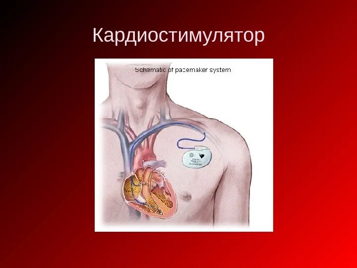 Установлен кардиостимулятор. Кардиостимулятор сердца. имплантация кардиостимулятора. постоянный кардиостимулятор. кардиостимулятор описание.