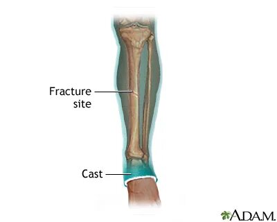 Fractura pedis transversa