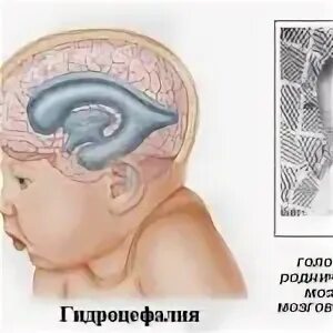 Ребенка внутренняя гидроцефалия