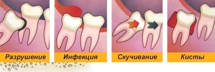 Когда в марте удалять зубы. Катаральный перикоронарит. Перикоронарит воспаление. Удалённый зуб мудрости.