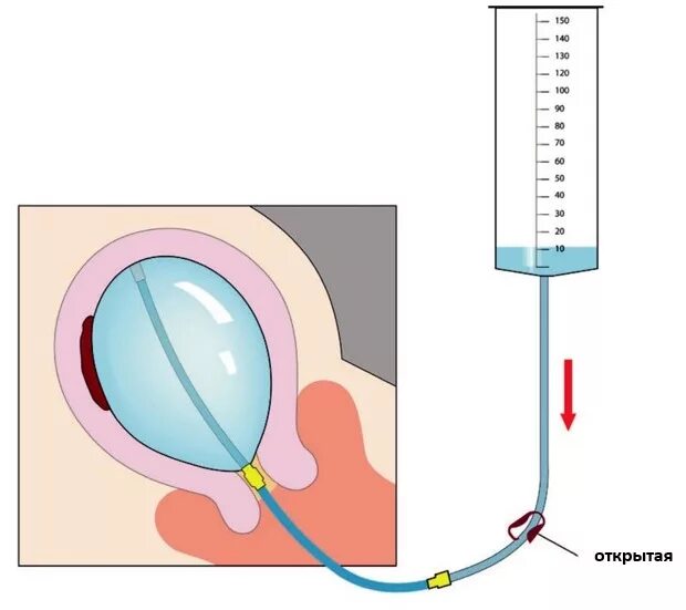 Баллонная тампонада матки Жуковского. Баллон Жуковского катетер маточный баллонный. Управляемая баллонная тампонада. Управляемая баллонная маточная тампонада. Катетер перед родами для раскрытия шейки матки