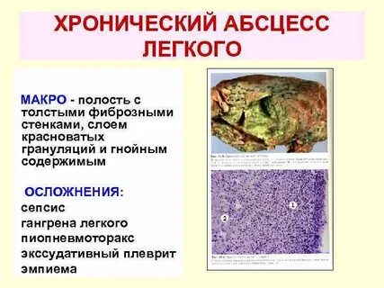 Абсцесс легкого