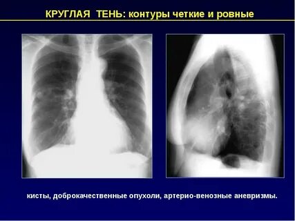 Четкие контуры очага в легком