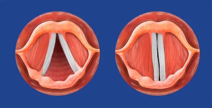 Ларингит ларингоскопия. Ларингоспазм ларингоскопия. Несмыкание голосовых связок. От чего зависят голосовые связки