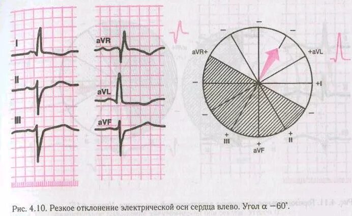 Сердце отклонено вправо. Отклонение оси влево на ЭКГ. Отклонение ЭОС на ЭКГ. Отклонение ЭОС влево на ЭКГ. Отклонение ЭОС резко влево на ЭКГ.