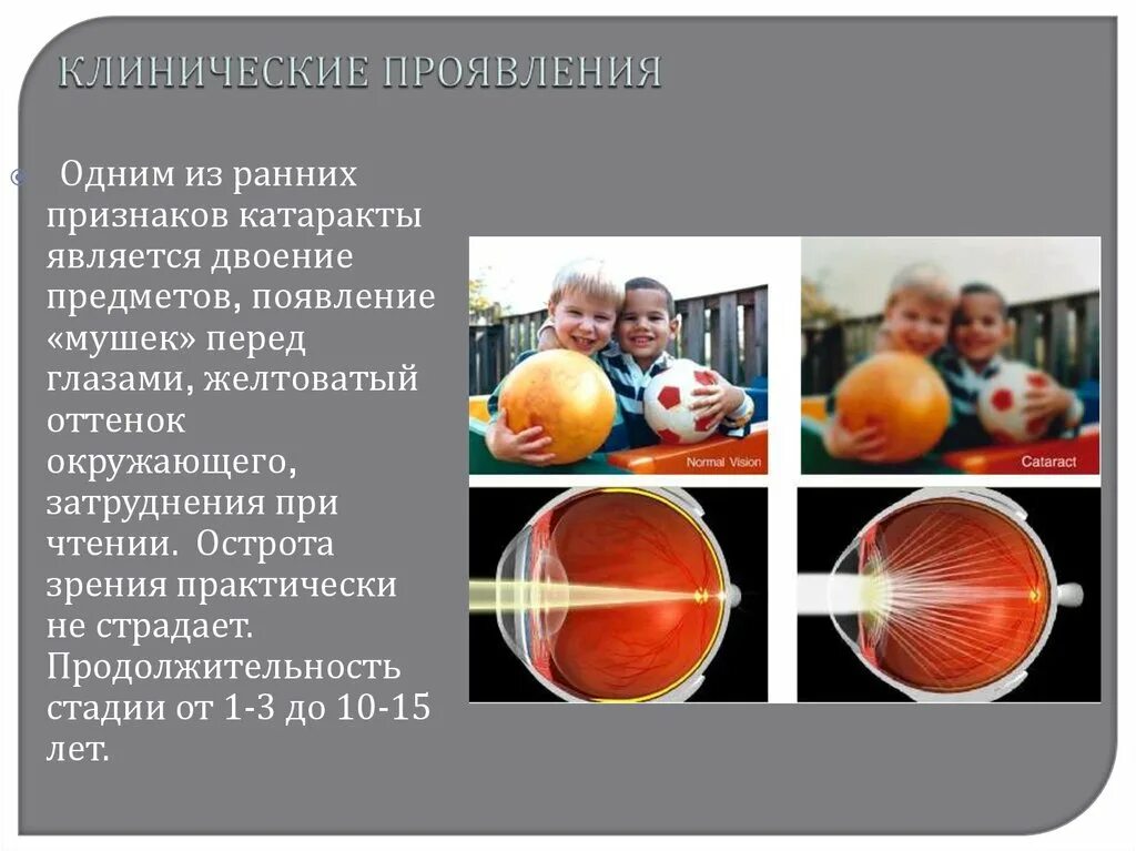 Клинические проявления катаракты. Презентация на тему катаракта. 1 признаки катаракты