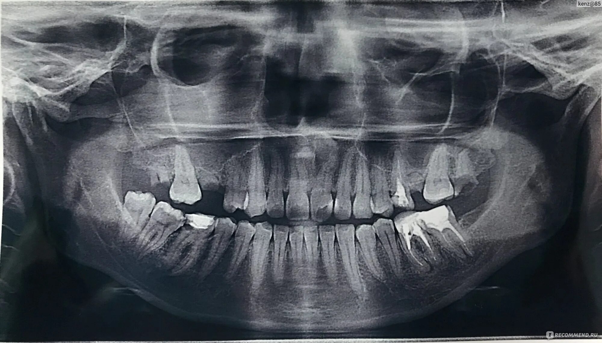 Снимок зубов видное. Одонтогенный гайморит рентген. Ортопантомография одонтогенный гайморит. Ортопантомограмма синусит.