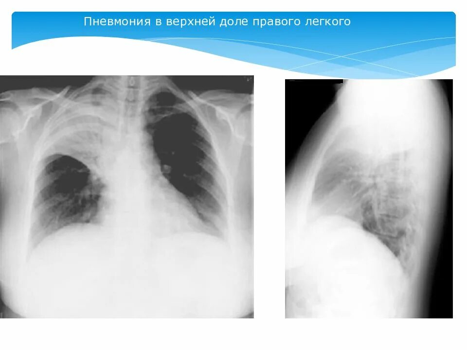 Рентгенография крупозной пневмонии. Долевая пневмония рентген. Правосторонняя очаговая пневмония рентген. Крупозная пневмония рентгенограмма. Изменения в верхней доле легкого