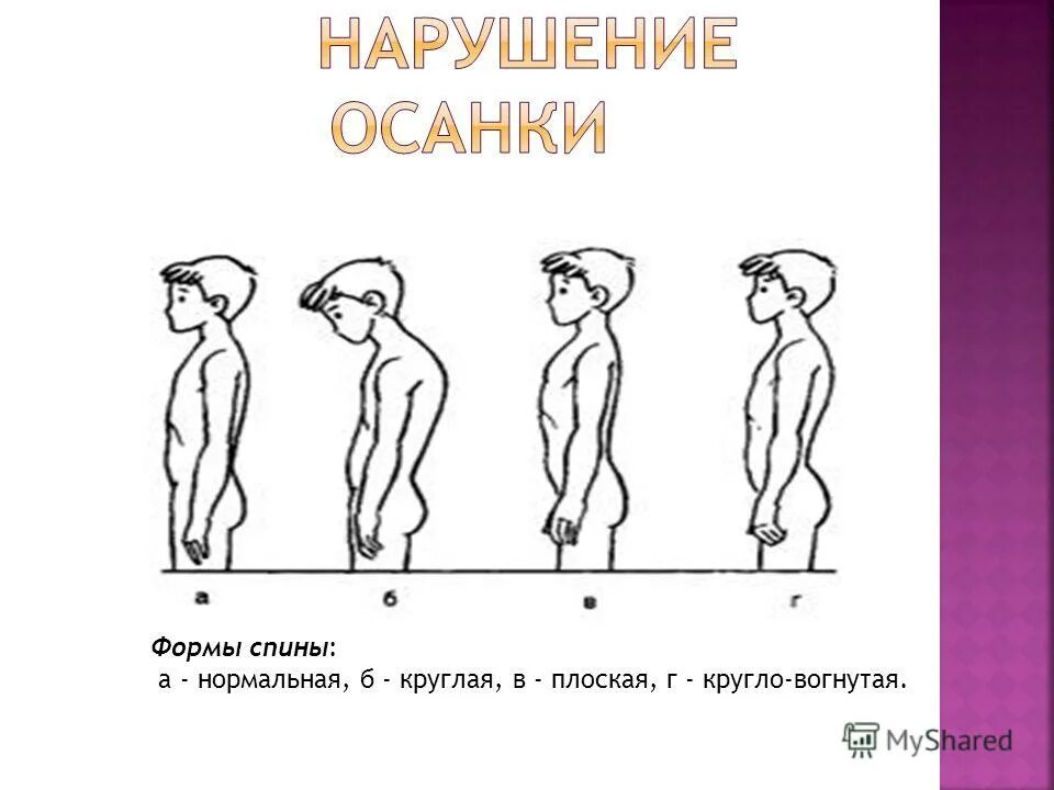 осанка лордоз кифоз сколиоз. уплощение спины. к соматоскопическим показателям физического развития относят. характеристика форм спины. характеристика форм спины.