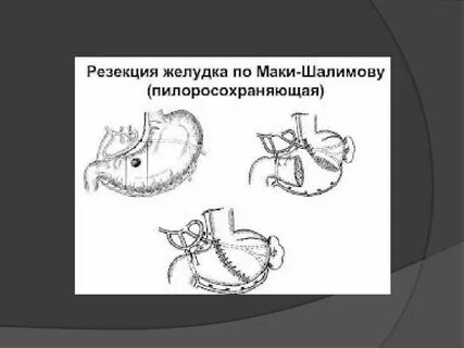 Опасна операция желудка