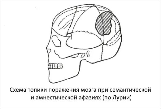 Акустико семантической афазии. Очаг поражения при семантической афазии. семантическая афазия зоны поражения мозга. семантическая афазия симптомы. очаг поражения при амнестической афазии.