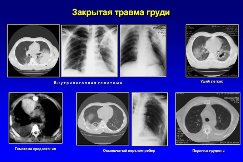 Травма легких после