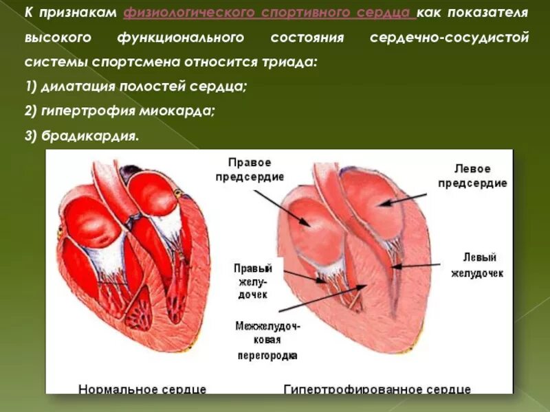 Спортивное сердце. Спортивное сердце симптомы. Физиологическое спортивное сердце. Дилатация спортивного сердца это.