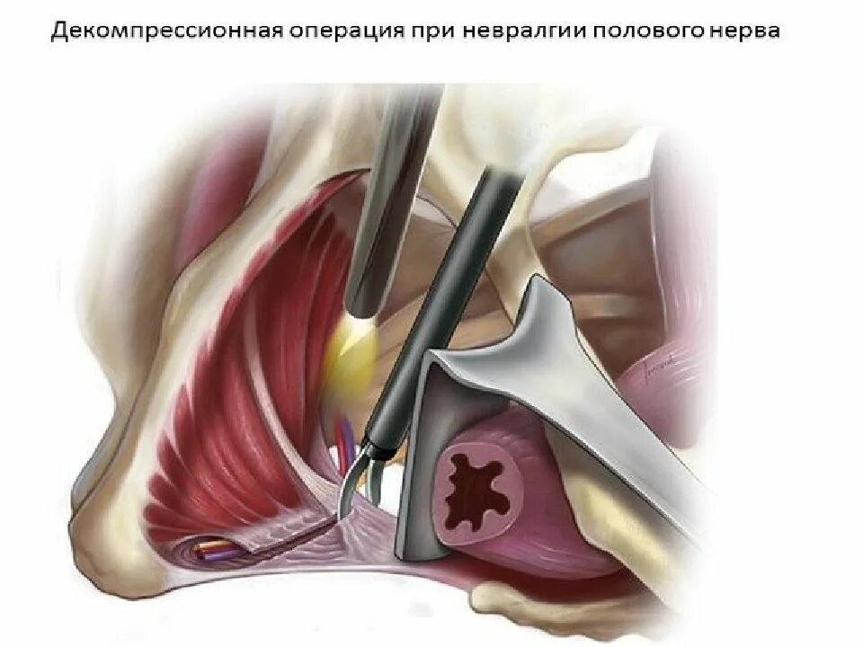 Блокады половые. Нейропатия бедренно-полового нерва. Пудендальный (срамной) нерв. Невралгия бедренно-полового нерва. Блокада бедренно-полового нерва.