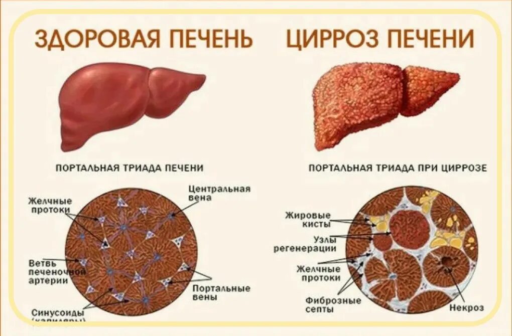 Кровь на цирроз печени