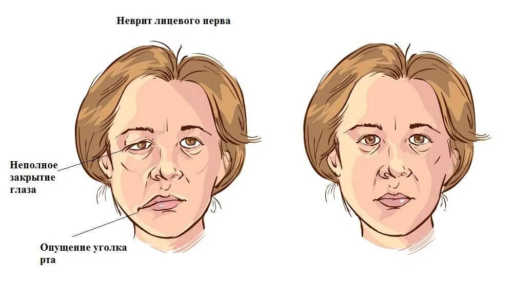 Почему человек опускается. Невропатия (неврит) лицевого нерва..