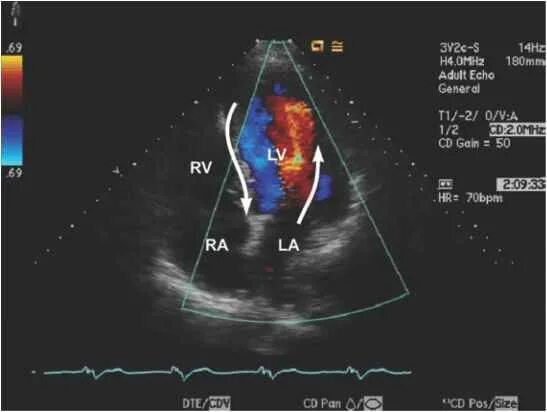 Доплер конечностей. Стрейн – эхокардиография. Echo Doppler. Colored Doppler Echocardiography. Синтетический допплер с «плавным суммированием».