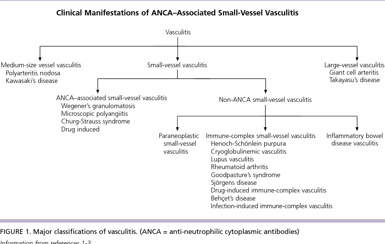 Anca-associated Vasculitis. АНЦА васкулит. Classification of systemic Vasculitis. АНЦА-ассоциированные васкулиты почки. Васкулит патогенез