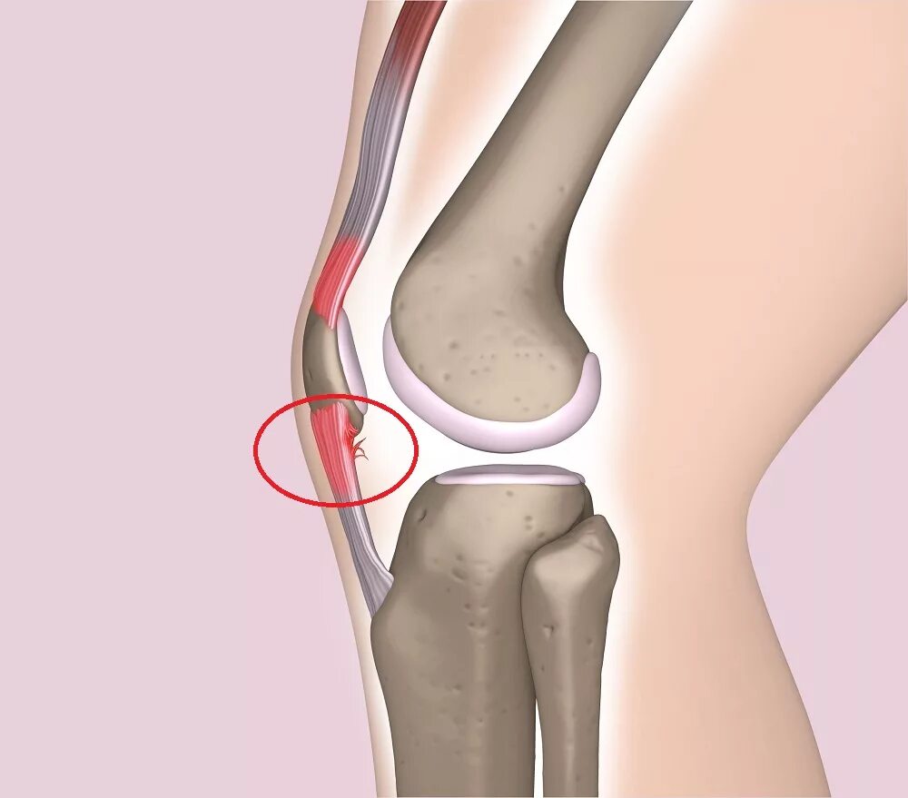 Тендинит коленных связок. Колено прыгуна тендинит надколенника. Тендинит сухожилия надколенника. Тендинит коленного сочленения. Тендинит связки надколенника.