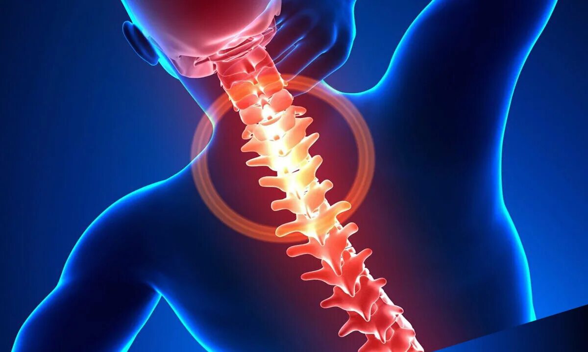 Хондроз шейного отдела позвоночника симптомы. Остин хондроз. Шейный хондроз. Хондроз позвоночника. Острый хондроз.