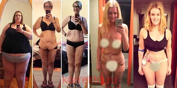 отвисшая кожа после похудения. после сильного похудения. быстрое снижение массы тела. сильное похудение.