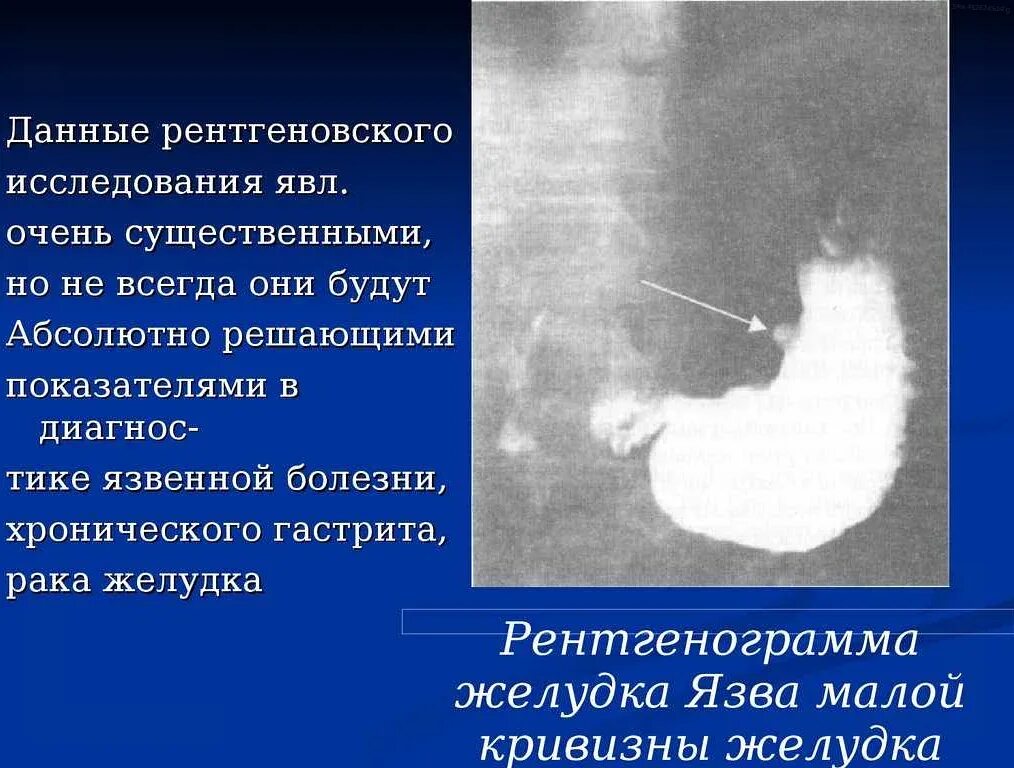 Язва желудка признаки и симптомы. Язва желудка признаки и симптомы. Проявления язвенной болезни желудка и 12-перстной кишки. Язвенная болезнь желудка симптомы. Основные симптомы язвенной болезни желудка и 12-перстной кишки.