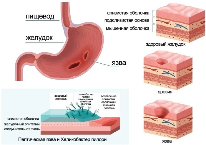 Препараты защищающие слизистую желудка