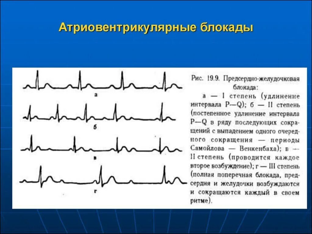 Блокада узла. Полная АВ блокада 3 степени ЭКГ. Полная атриовентрикулярная блокада на ЭКГ. Атриовентрикулярные блокады на ЭКГ. Полная атриовентрикулярная блокада 3 степени на ЭКГ.