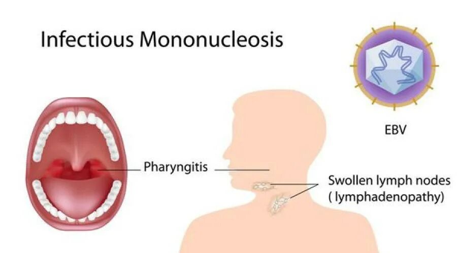 Мононуклеоз это. Инфекционный мононуклеоз гепатоспленомегалия. Инфекционный мононуклеоз мрт. Инфографика мононуклеоз.