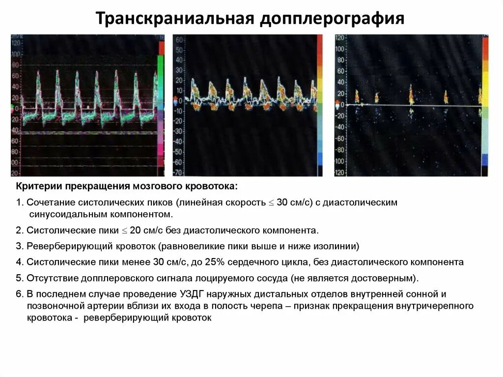 Транскраниальная ультразвуковая допплерография сосудов головного. Лазерной допплеровской флоуметрии схема. Реверберирующий кровоток при допплерографии. Транскраниальная допплерография при смерти мозга. Транскраниальные артерии и вены