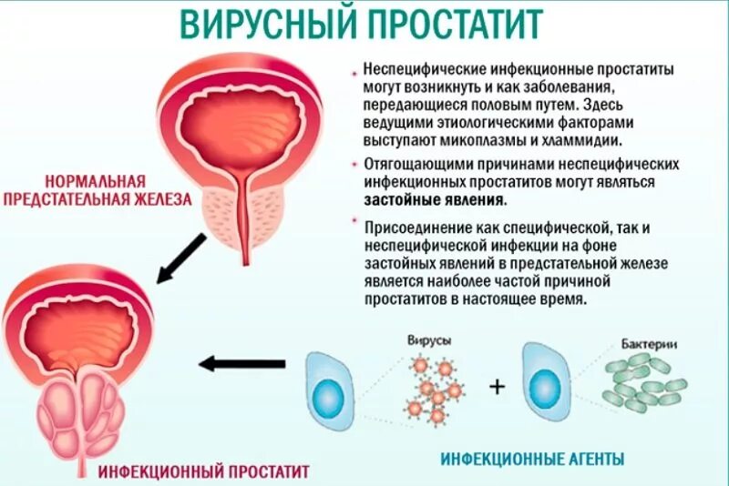 Передается ли простатит. Хронический простатит. воспаление предстательной железы. инфекционный простатит.