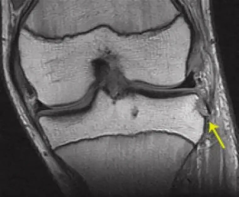 Мрт коленного сустава разрыв мениска. ПКС коленного сустава мрт. Разрыв ПКС коленного сустава на мрт.
