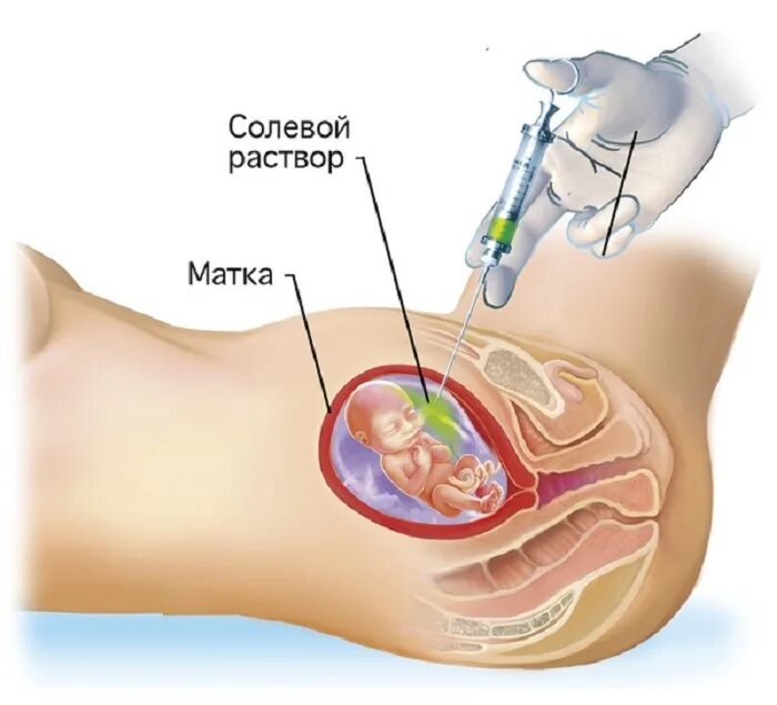 Метод интраамниального введения жидкостей.. Интраамниальное Введение гипертонического раствора. Роды 18 недель