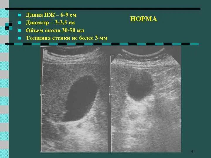 Диаметр желчного пузыря. Эхограмма желчного пузыря. Объём желчного пузыря на УЗИ В норме у детей. Стенка желчного пузыря норма на УЗИ. Ультразвуковое исследование желчный пузырь норма.
