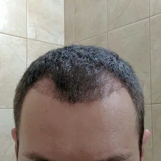 10 дней после пересадки