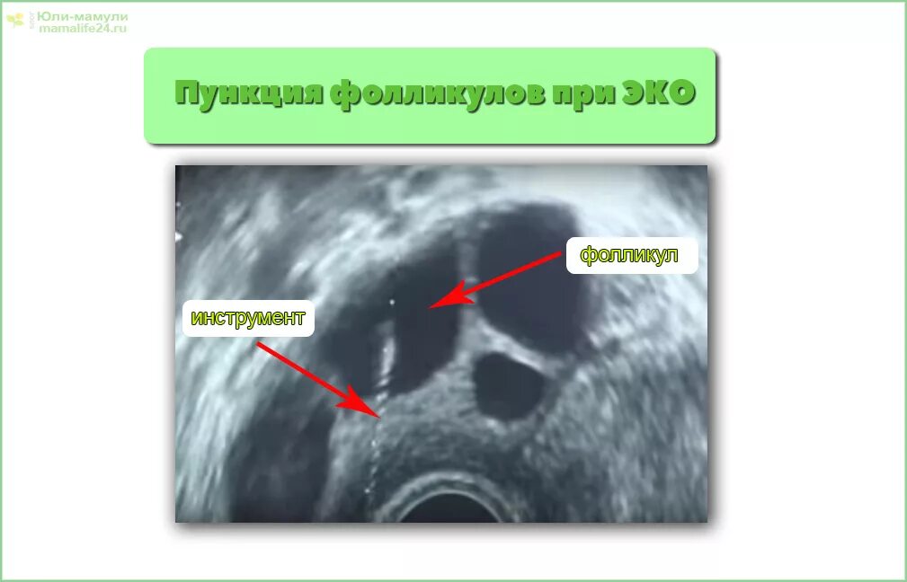 Боли после пункции фолликулов. Пункция фолликулов яичника. После пункции фолликулов. УЗИ после пункции фолликулов. Пункция фолликулов при эко.