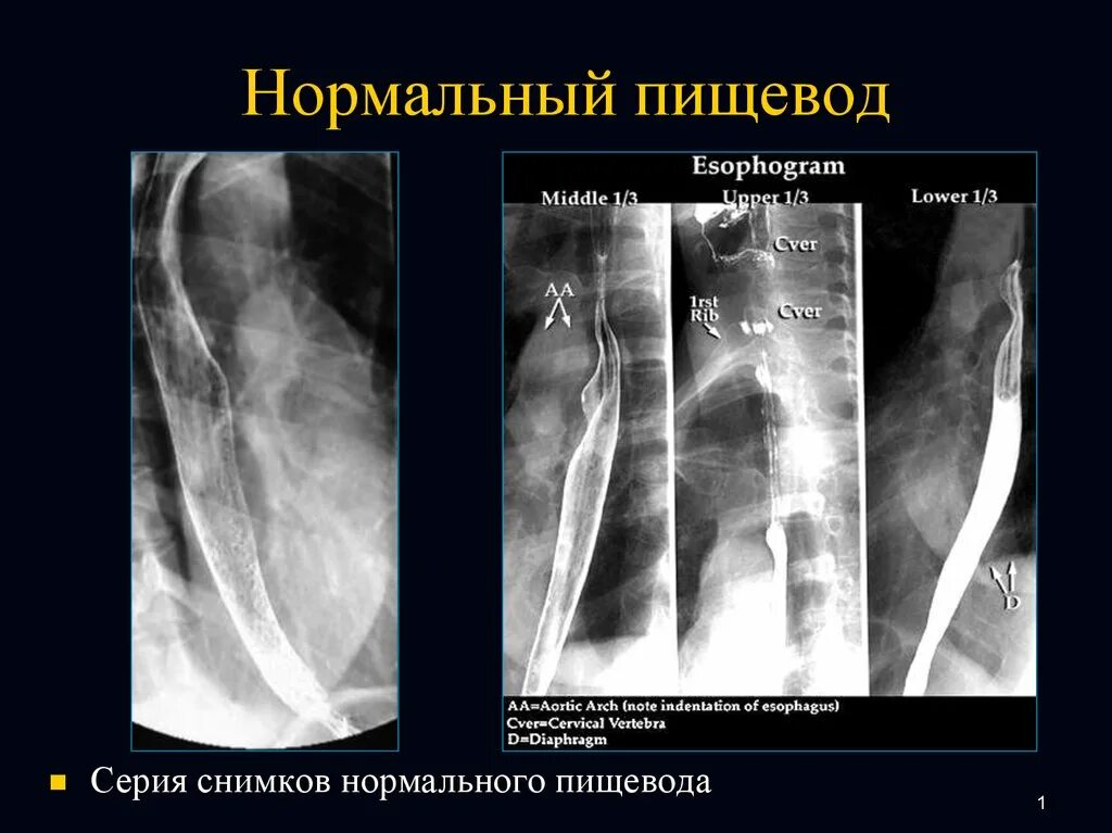 Пищевода с барием. Рентгеноконтрастное исследование пищевода. Стриктура пищевода рентген. Стеноз пищевода рентгенограмма.