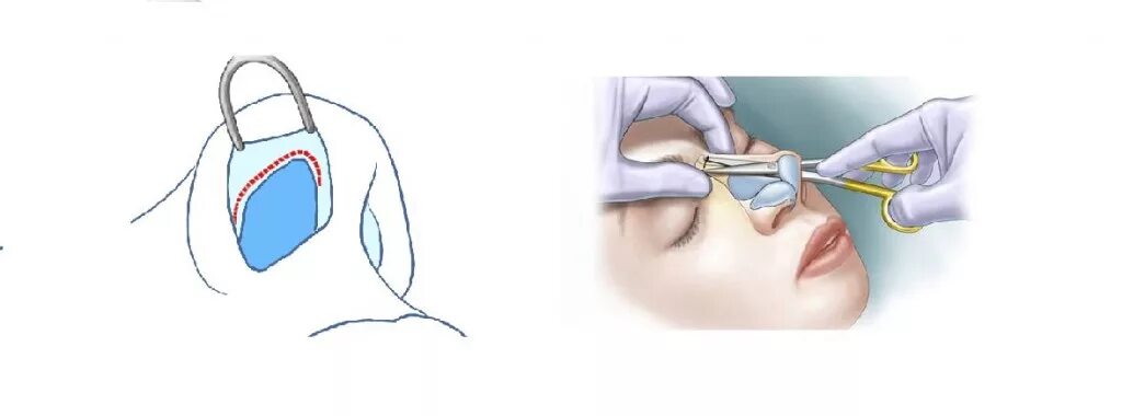 Операция носовой перегородки по омс