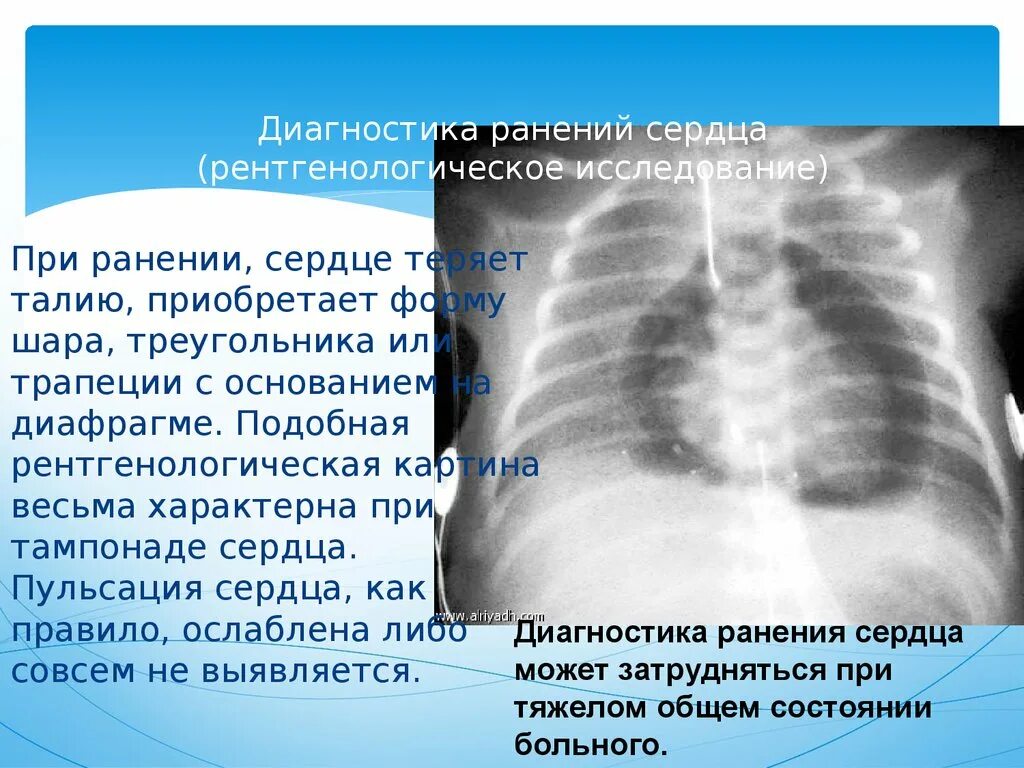 Пороки сердца на рентгенограмме. Рентгенодиагностика сердца. Ранение сердца диагностика. В сердце раны в легких никотин