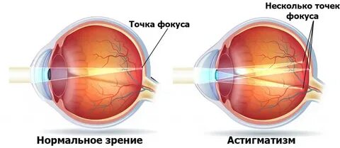 Астигматизм лечение у детей